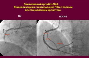 Caractéristiques de la mise en œuvre de la recanalisation du thrombus