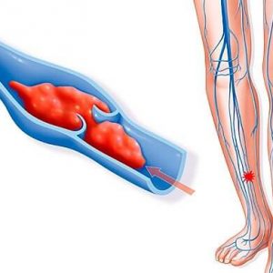 Caractéristiques de la mise en œuvre de la recanalisation du thrombus