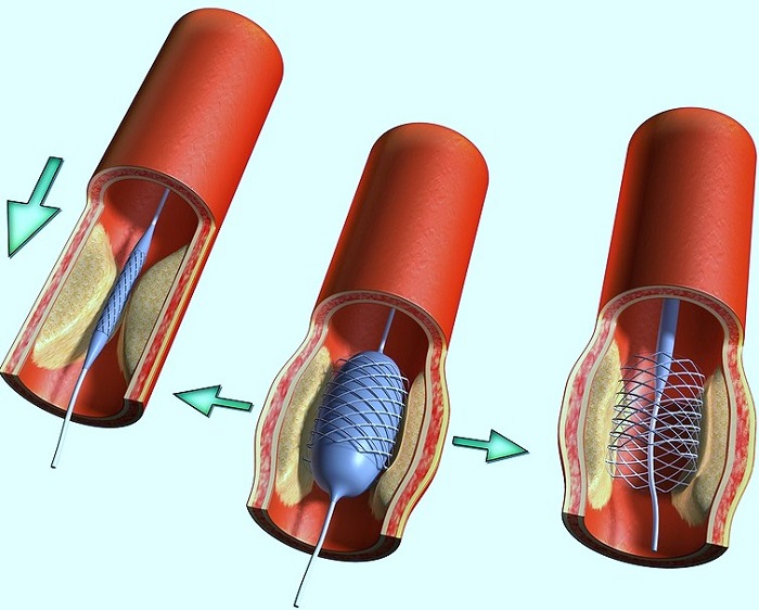 Caractéristiques de la mise en œuvre de la recanalisation du thrombus